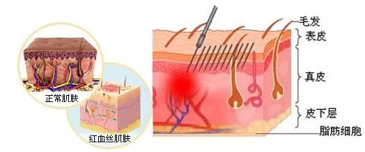 红血丝是什么原因导致的